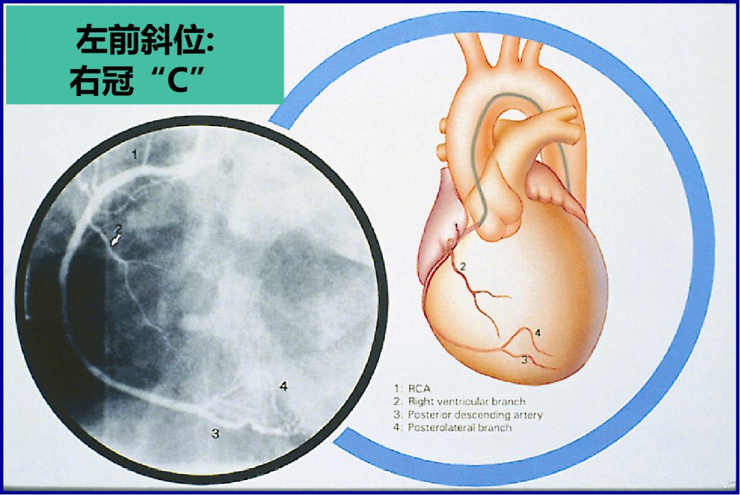 造影导丝是什么珍藏 冠脉造影从流程到诊断，基础必备！_https://www.jmylbn.com_新闻资讯_第52张