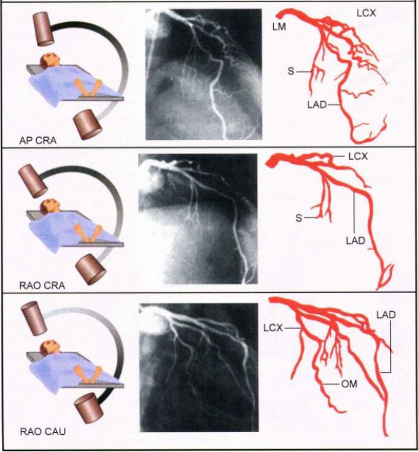造影导丝是什么珍藏 冠脉造影从流程到诊断，基础必备！_https://www.jmylbn.com_新闻资讯_第43张