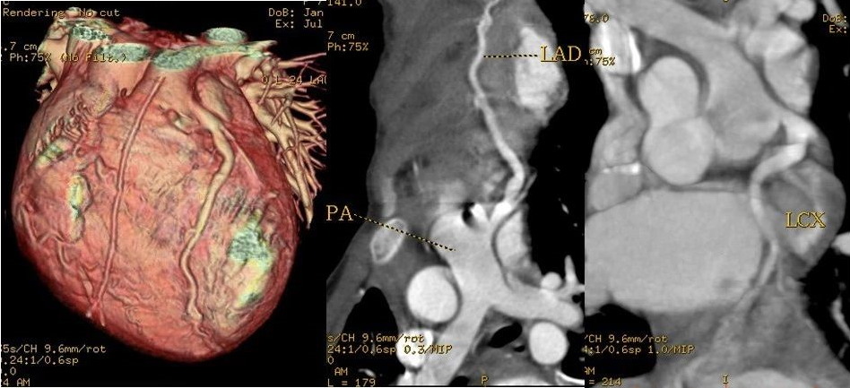 早读 冠脉cta天天看 你真的懂它吗 养生堂 日常养生保健大全 养生小知识 微信头条新闻公众号文章收集网