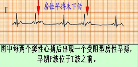什么是同步心电图心电图学不会、记不住？这个合集very good！_https://www.jmylbn.com_新闻资讯_第19张