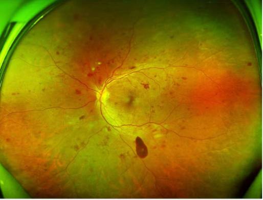 怎么看眼底相机世界睛彩 尽收眼底——你不知道的神奇“眼底照相机”_https://www.jmylbn.com_新闻资讯_第5张