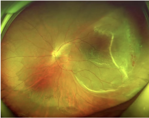 怎么看眼底相机世界睛彩 尽收眼底——你不知道的神奇“眼底照相机”_https://www.jmylbn.com_新闻资讯_第7张