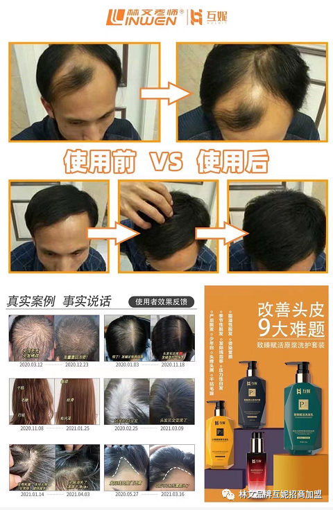 头皮也会衰老就问你怕不怕？