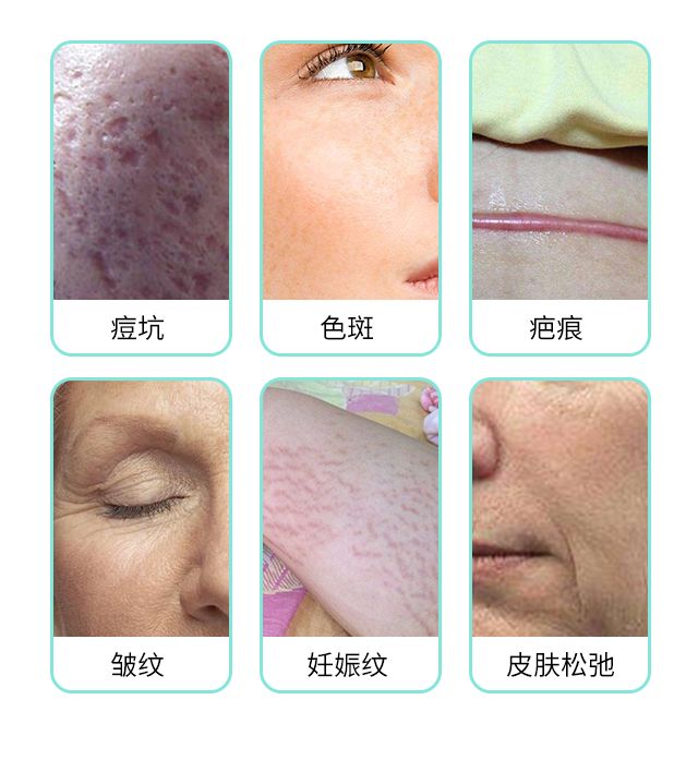 二氧化碳(co2)激光治疗是什么二氧化碳（CO₂）点阵激光，除了治疗痘坑还有哪些功能？_https://www.jmylbn.com_新闻资讯_第8张