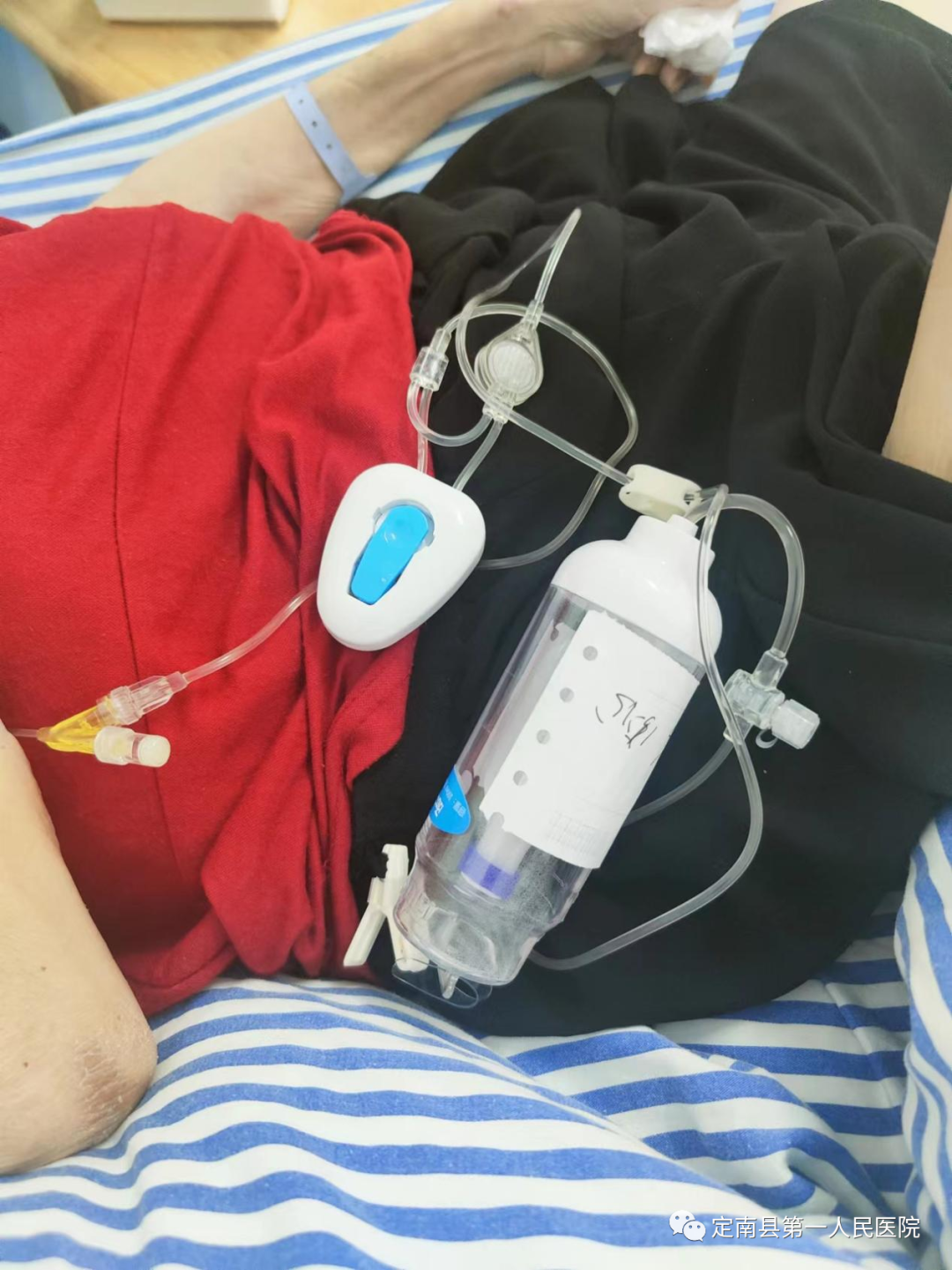 pca泵是什么肿瘤科开展镇痛泵技术(PCA)，让癌症患者远离疼痛!_https://www.jmylbn.com_新闻资讯_第8张