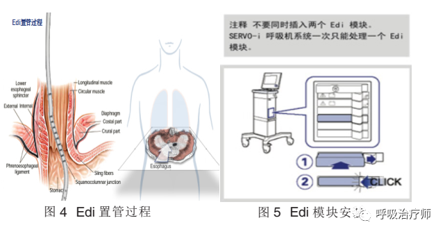 呼吸机模式怎么调节呼吸机模式-NAVA／MMV_https://www.jmylbn.com_新闻资讯_第4张