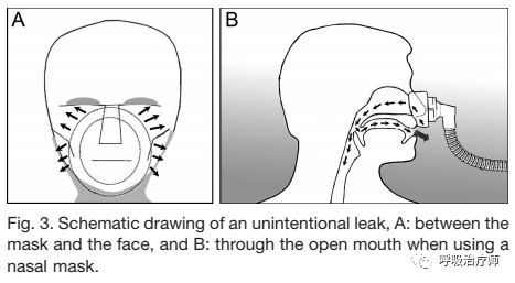 怎么按面罩不漏气文献解读-无创正压通气时面罩的选择（续）_https://www.jmylbn.com_新闻资讯_第2张