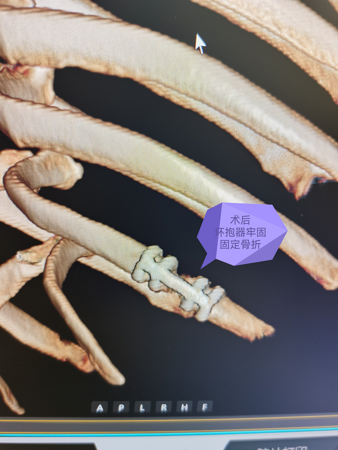 肋骨怎么记忆被“牢牢把握”的骨折—记我院首例记忆合金环抱器切开复位内固定术_https://www.jmylbn.com_新闻资讯_第6张
