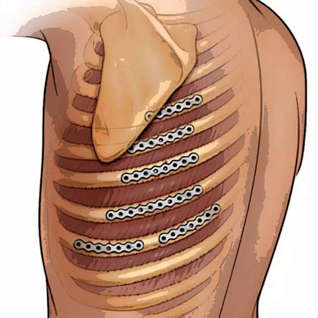 肋骨怎么记忆被“牢牢把握”的骨折—记我院首例记忆合金环抱器切开复位内固定术_https://www.jmylbn.com_新闻资讯_第3张