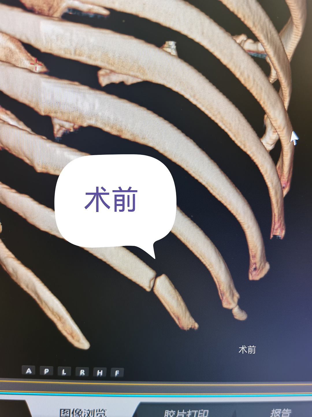 肋骨怎么记忆被“牢牢把握”的骨折—记我院首例记忆合金环抱器切开复位内固定术_https://www.jmylbn.com_新闻资讯_第5张