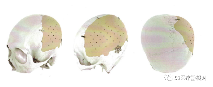 神经外科的耗材有哪些会员动态｜ 河南科洛德医疗器械有限公司诚意寻找合作伙伴！_https://www.jmylbn.com_新闻资讯_第6张