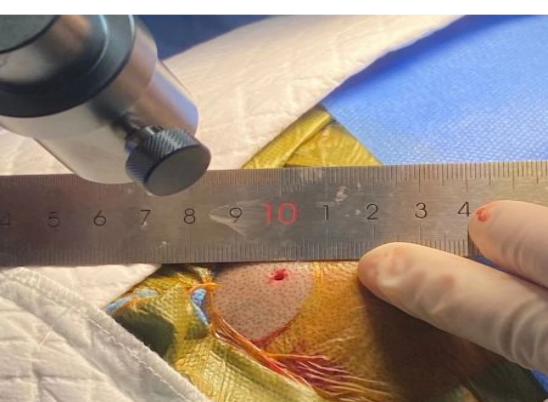 手术床怎么准备手术配合 ｜ 宁波市第一医院——机器人辅助立体定向脑组织穿刺活检术手术配合与管理_https://www.jmylbn.com_新闻资讯_第11张