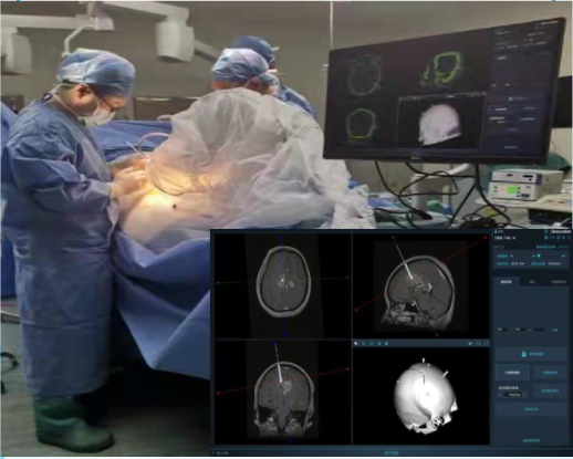 手术床怎么准备手术配合 ｜ 宁波市第一医院——机器人辅助立体定向脑组织穿刺活检术手术配合与管理_https://www.jmylbn.com_新闻资讯_第8张