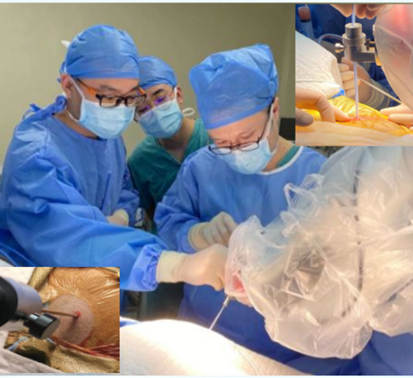 手术床怎么准备手术配合 ｜ 宁波市第一医院——机器人辅助立体定向脑组织穿刺活检术手术配合与管理_https://www.jmylbn.com_新闻资讯_第9张