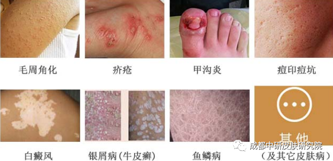 皮肤病图片识别【99皮肤病的种类图片大全】你可以看看是哪一种