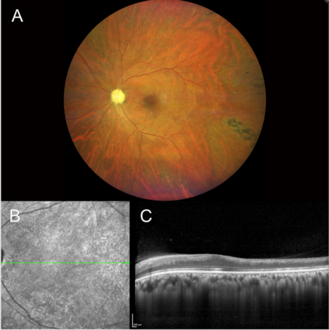 neuroretinopathy图片