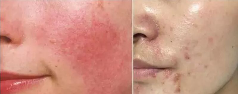 被子里的螨虫咬人吗_螨虫咬人后症状图片_怎么判断是螨虫咬的包