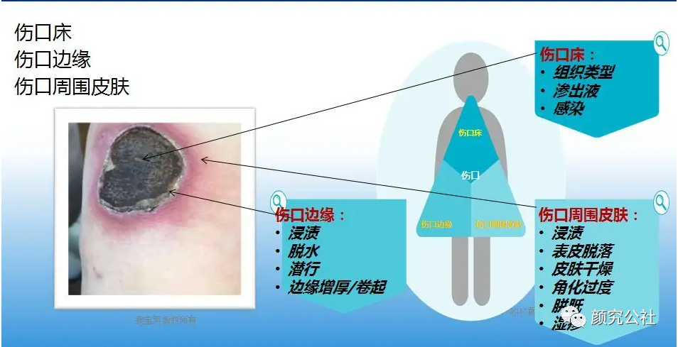 人工敷料怎么照顾伤口伤口分类及护理原则（五）：敷料的选择和选分类_https://www.jmylbn.com_新闻资讯_第4张