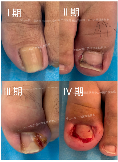 趾甲 “叛逆” 扎进肉里，孩子走路难忍受｜中山一院广西医院科学应对方案