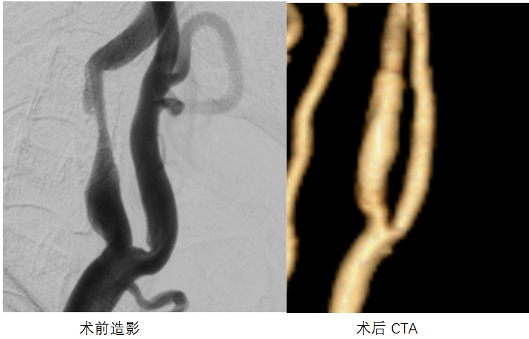 疏通大脑供血 “生命线”| 中山一院广西医院完成高难度CEA手术 为患者筑牢卒中防线