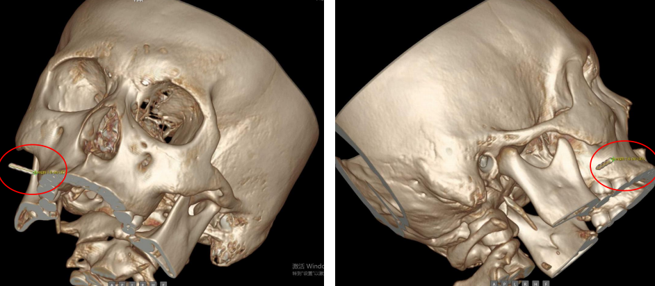 绣花针挑痘 针断脸内 | 中山一院广西医院多学科协作精准取针化危机