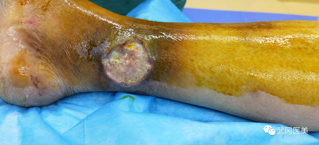 为什么负压引流VSD负压封闭引流术的护理_https://www.jmylbn.com_新闻资讯_第1张