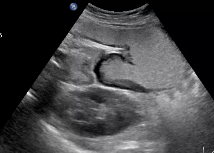 胃造影用的是什么机子超声诊断科新技术｜胃肠超声造影检查，让您舒舒服服做完肠胃筛查！_https://www.jmylbn.com_新闻资讯_第6张