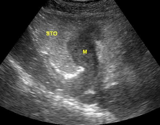 胃造影用的是什么机子超声诊断科新技术｜胃肠超声造影检查，让您舒舒服服做完肠胃筛查！_https://www.jmylbn.com_新闻资讯_第9张