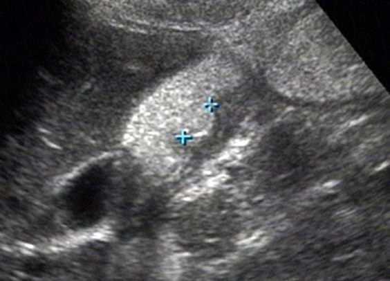 胃造影用的是什么机子超声诊断科新技术｜胃肠超声造影检查，让您舒舒服服做完肠胃筛查！_https://www.jmylbn.com_新闻资讯_第8张