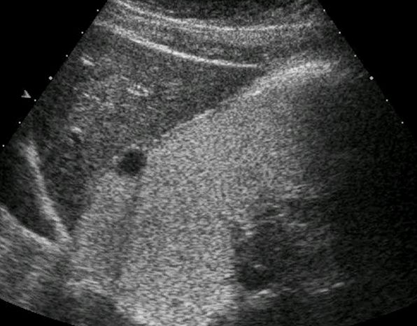 胃造影用的是什么机子超声诊断科新技术｜胃肠超声造影检查，让您舒舒服服做完肠胃筛查！_https://www.jmylbn.com_新闻资讯_第7张