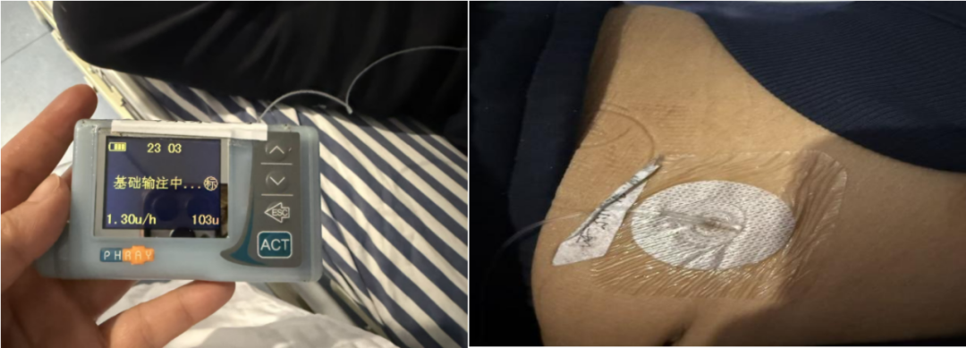 为什么要用泵打针告别传统注射方式，胰岛素泵为糖尿病管理带来智能化守护_https://www.jmylbn.com_新闻资讯_第2张