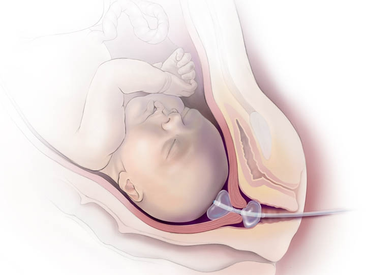 cook球囊怎么取超预产期不发动？COOK球囊来帮忙_https://www.jmylbn.com_新闻资讯_第6张
