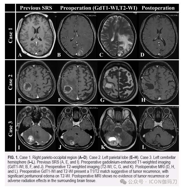 病理切片快递怎么包装【文献快递】初次立体定向放射外科治疗后再程照射后切除复发性脑转移瘤：说明性病例_https://www.jmylbn.com_新闻资讯_第3张