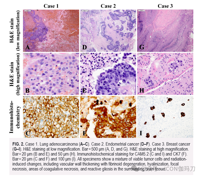 病理切片快递怎么包装【文献快递】初次立体定向放射外科治疗后再程照射后切除复发性脑转移瘤：说明性病例_https://www.jmylbn.com_新闻资讯_第4张