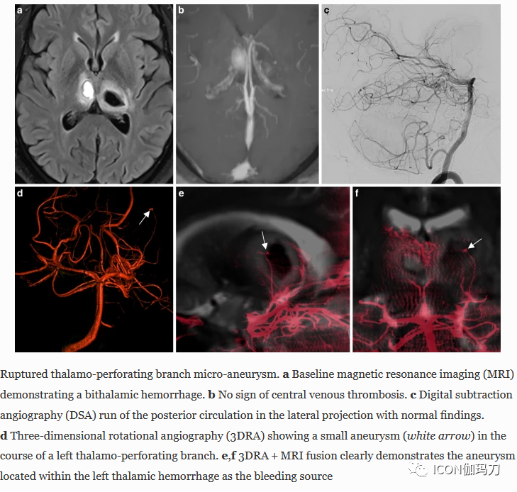 病理切片快递怎么包装【文献快递】先进的三维DSA和MRI／CT融合在神经血管病理中的价值_https://www.jmylbn.com_新闻资讯_第3张