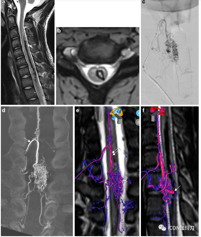 病理切片快递怎么包装【文献快递】先进的三维DSA和MRI／CT融合在神经血管病理中的价值_https://www.jmylbn.com_新闻资讯_第4张