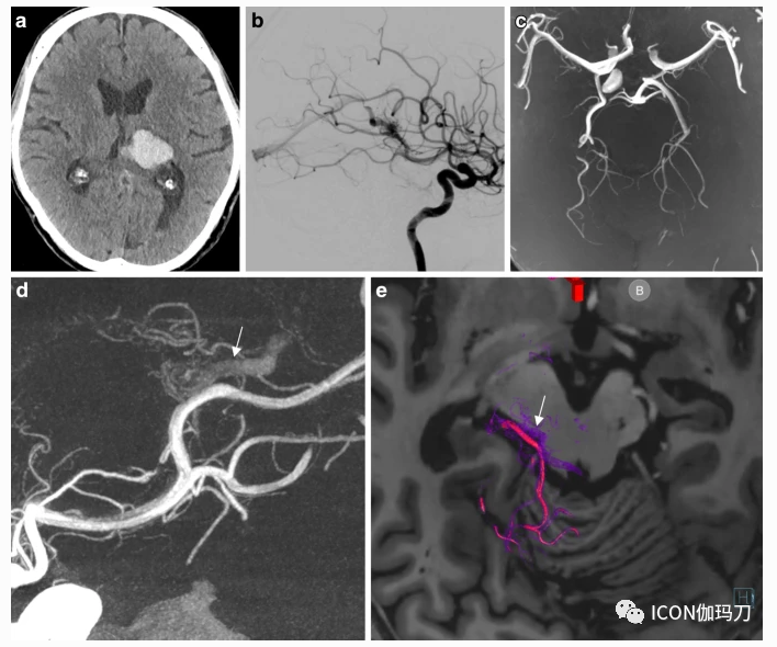 病理切片快递怎么包装【文献快递】先进的三维DSA和MRI／CT融合在神经血管病理中的价值_https://www.jmylbn.com_新闻资讯_第6张