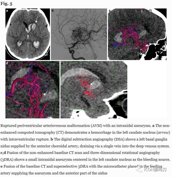病理切片快递怎么包装【文献快递】先进的三维DSA和MRI／CT融合在神经血管病理中的价值_https://www.jmylbn.com_新闻资讯_第8张