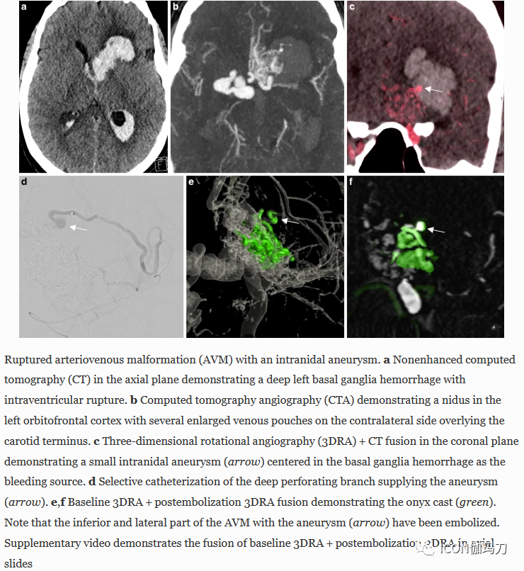 病理切片快递怎么包装【文献快递】先进的三维DSA和MRI／CT融合在神经血管病理中的价值_https://www.jmylbn.com_新闻资讯_第2张