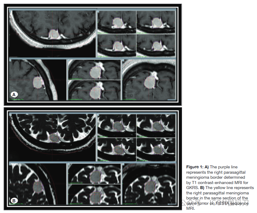 性干涉怎么治疗【文献快递】伽玛刀放射外科治疗单发脑膜瘤的新视角：在磁共振成像稳态采集／稳态干涉快速成像中的适应性_https://www.jmylbn.com_新闻资讯_第2张