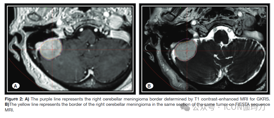 性干涉怎么治疗【文献快递】伽玛刀放射外科治疗单发脑膜瘤的新视角：在磁共振成像稳态采集／稳态干涉快速成像中的适应性_https://www.jmylbn.com_新闻资讯_第3张