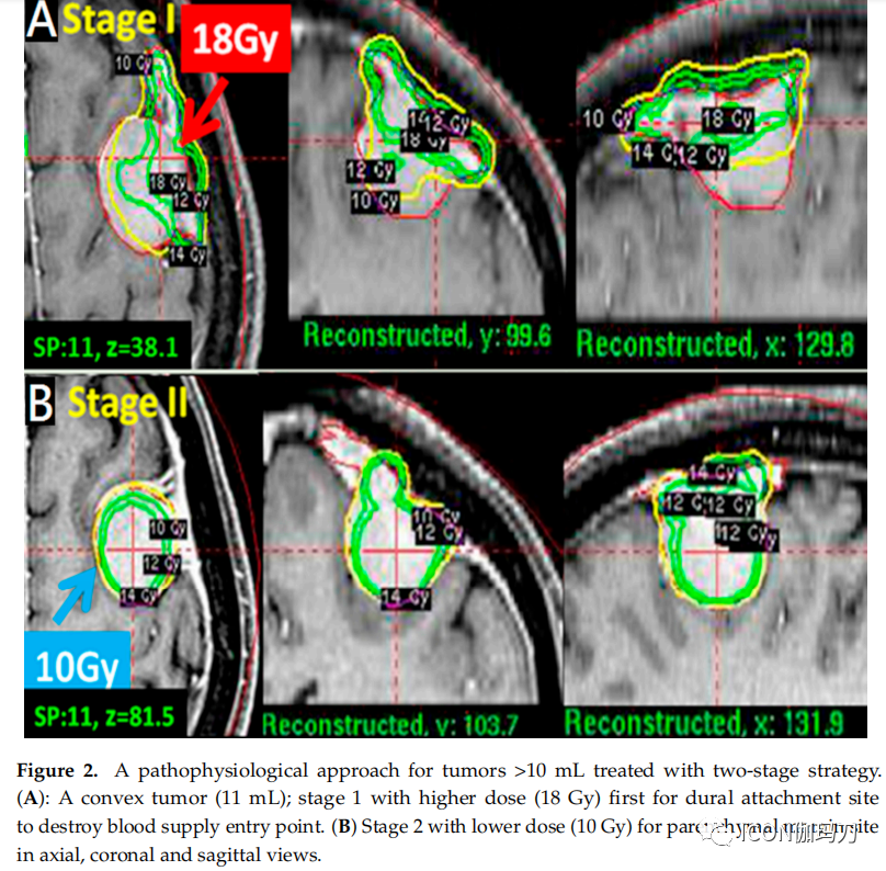 病理切片快递怎么包装【文献快递】减少伽玛刀放射外科治疗大的意外偶发脑膜瘤瘤周脑水肿的病理生理学方法_https://www.jmylbn.com_新闻资讯_第3张