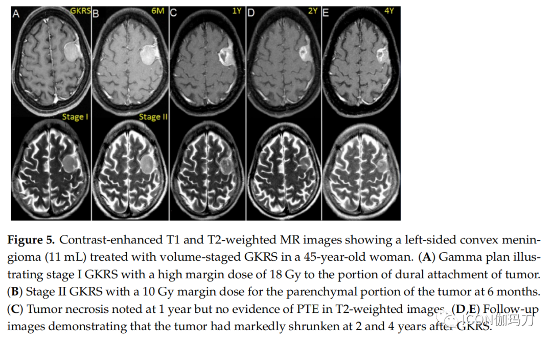 病理切片快递怎么包装【文献快递】减少伽玛刀放射外科治疗大的意外偶发脑膜瘤瘤周脑水肿的病理生理学方法_https://www.jmylbn.com_新闻资讯_第8张