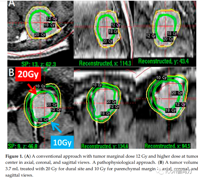 病理切片快递怎么包装【文献快递】减少伽玛刀放射外科治疗大的意外偶发脑膜瘤瘤周脑水肿的病理生理学方法_https://www.jmylbn.com_新闻资讯_第2张