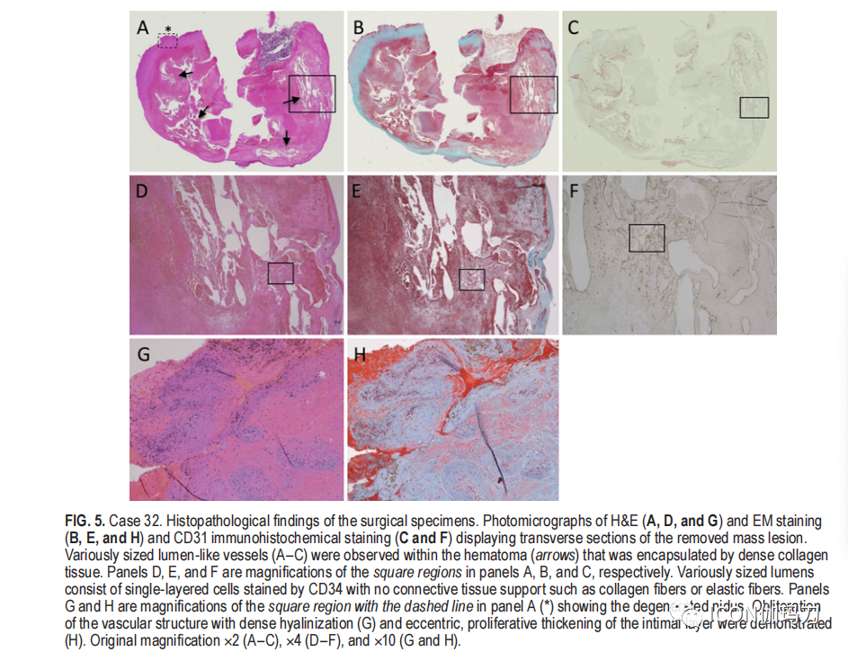 病理切片快递怎么包装【文献快递】类似海绵状血管畸形的网状内皮增生是伽玛刀放射外科的晚期并发症_https://www.jmylbn.com_新闻资讯_第10张