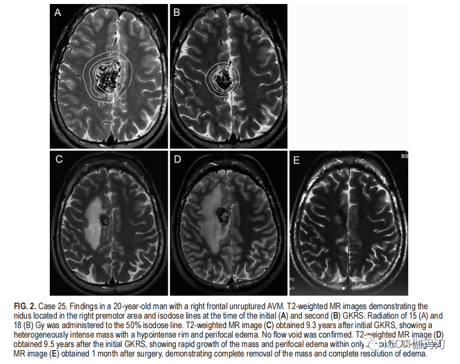 病理切片快递怎么包装【文献快递】类似海绵状血管畸形的网状内皮增生是伽玛刀放射外科的晚期并发症_https://www.jmylbn.com_新闻资讯_第7张