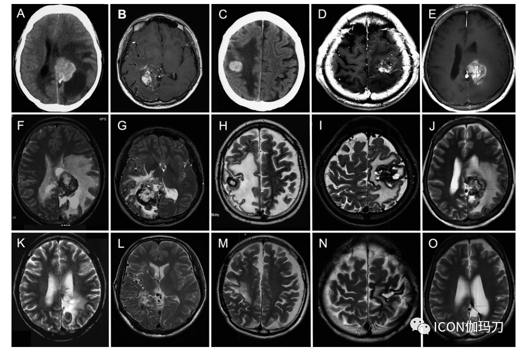 病理切片快递怎么包装【文献快递】类似海绵状血管畸形的网状内皮增生是伽玛刀放射外科的晚期并发症_https://www.jmylbn.com_新闻资讯_第5张