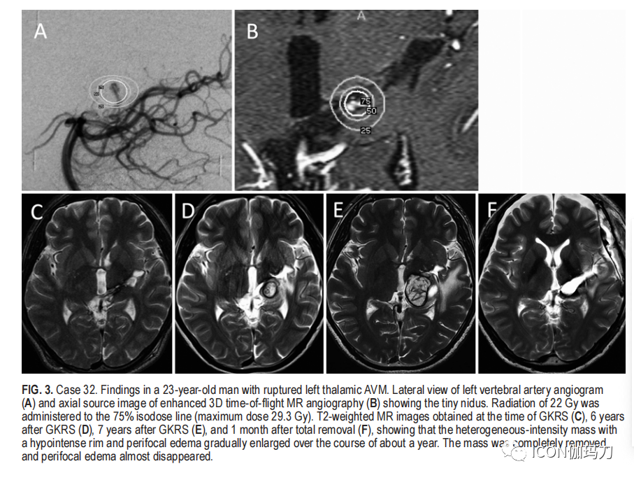 病理切片快递怎么包装【文献快递】类似海绵状血管畸形的网状内皮增生是伽玛刀放射外科的晚期并发症_https://www.jmylbn.com_新闻资讯_第8张