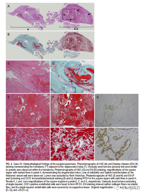 病理切片快递怎么包装【文献快递】类似海绵状血管畸形的网状内皮增生是伽玛刀放射外科的晚期并发症_https://www.jmylbn.com_新闻资讯_第9张