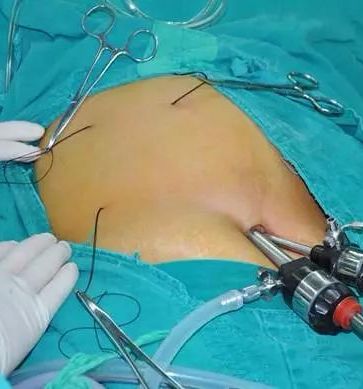 微切口腹腔镜胆囊切除术 - 好大夫在线